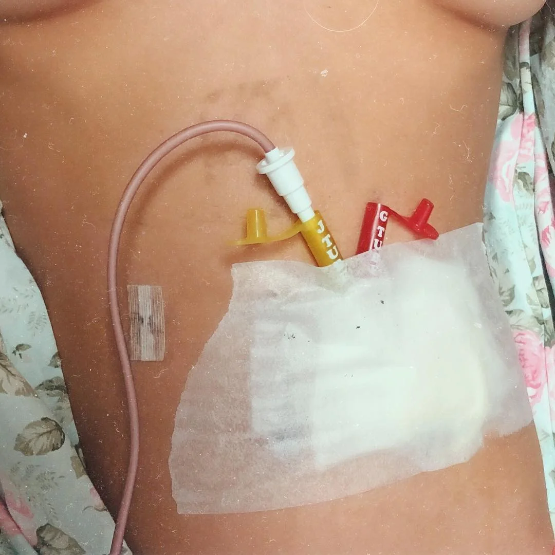 Passando pra falar um pouquinho da cirurgia que fiz! Vi muitos falando que fiz pra retirar o tumor, outros que fiz pra tirar a sonda... Na verdade tirei a sonda do nariz mas colocaram uma na minha barriga pra eu continuar minha alimentação, que foi uma laparoscopia mais jejunostomia, infelizmente a doença não diminuiu ao ponto de fazer uma cirurgia de retirada, o que fizemos foi só uma parte do processo, temos muitos caminhos a percorrer ainda. Obrigada pelo carinho e compreensão de todos que me desejaram força pois isso foi necessário pra mim me sentir mais forte. Precisei de tempo pra me recuperar e dei uma sumidinha, mas to de volta! Agradeço muito a Deus por tudo ter dado certo e agradeço também a galera da @limonemodas que patrocinou a vinda da minha vozinha e duas primas pra cá, passar esse momento com pessoas especiais é essencial pra minha recuperação!! Só gratidão 💗