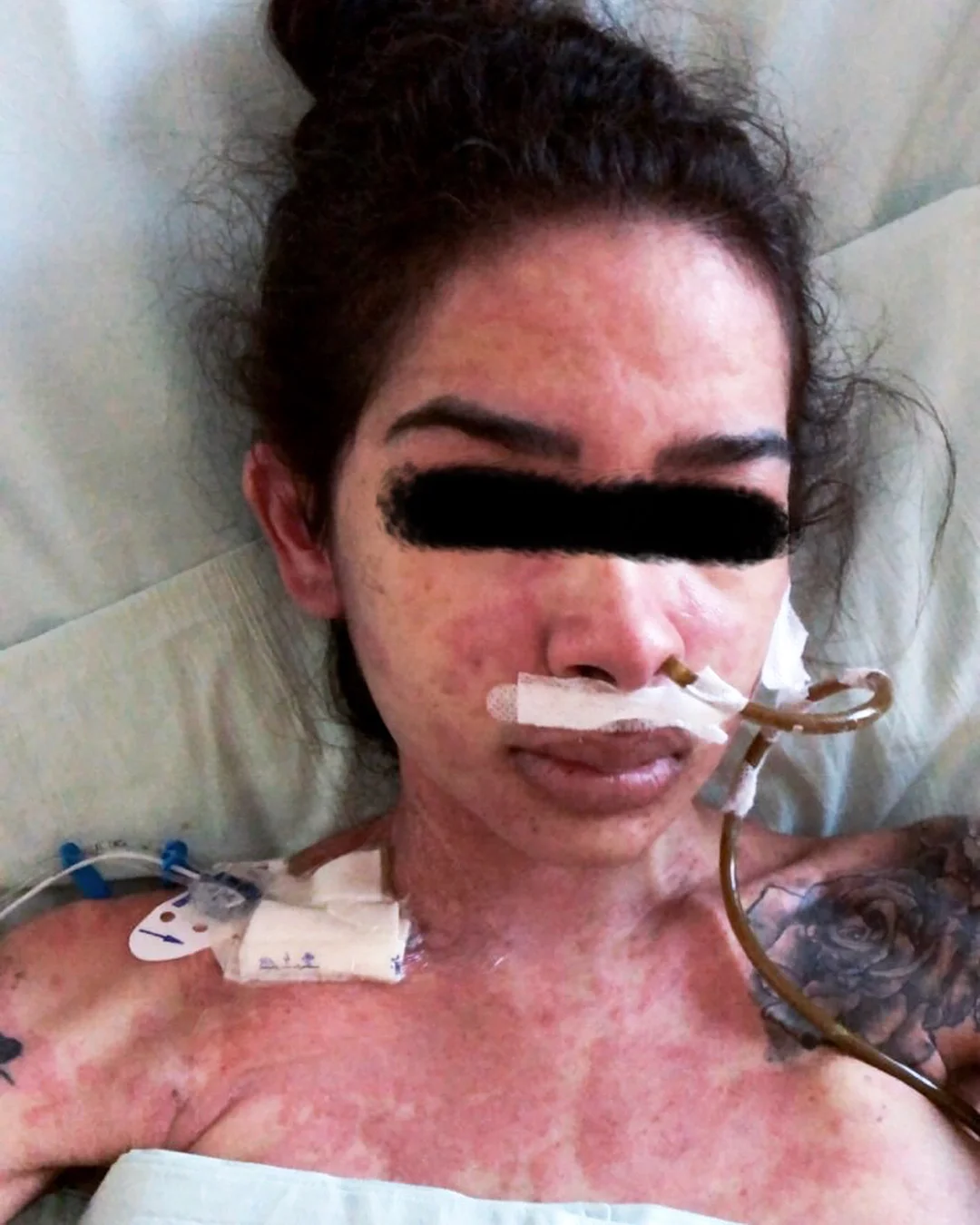 Esses últimos dias foram mt difíceis, tive uma reação alérgica aos medicamentos e meu corpo ficou todo assim.. uma coceira infinita, febre, garganta inflamada, gritava de dores pq arde bastante. Eu só peço a Deus misericórdia pq não tá fácil passar por isso. Só eu e Deus sabemos o quanto tem sido difícil, mas tenho certeza que ele tem um plano muito maior na minha vida. 🙏💙